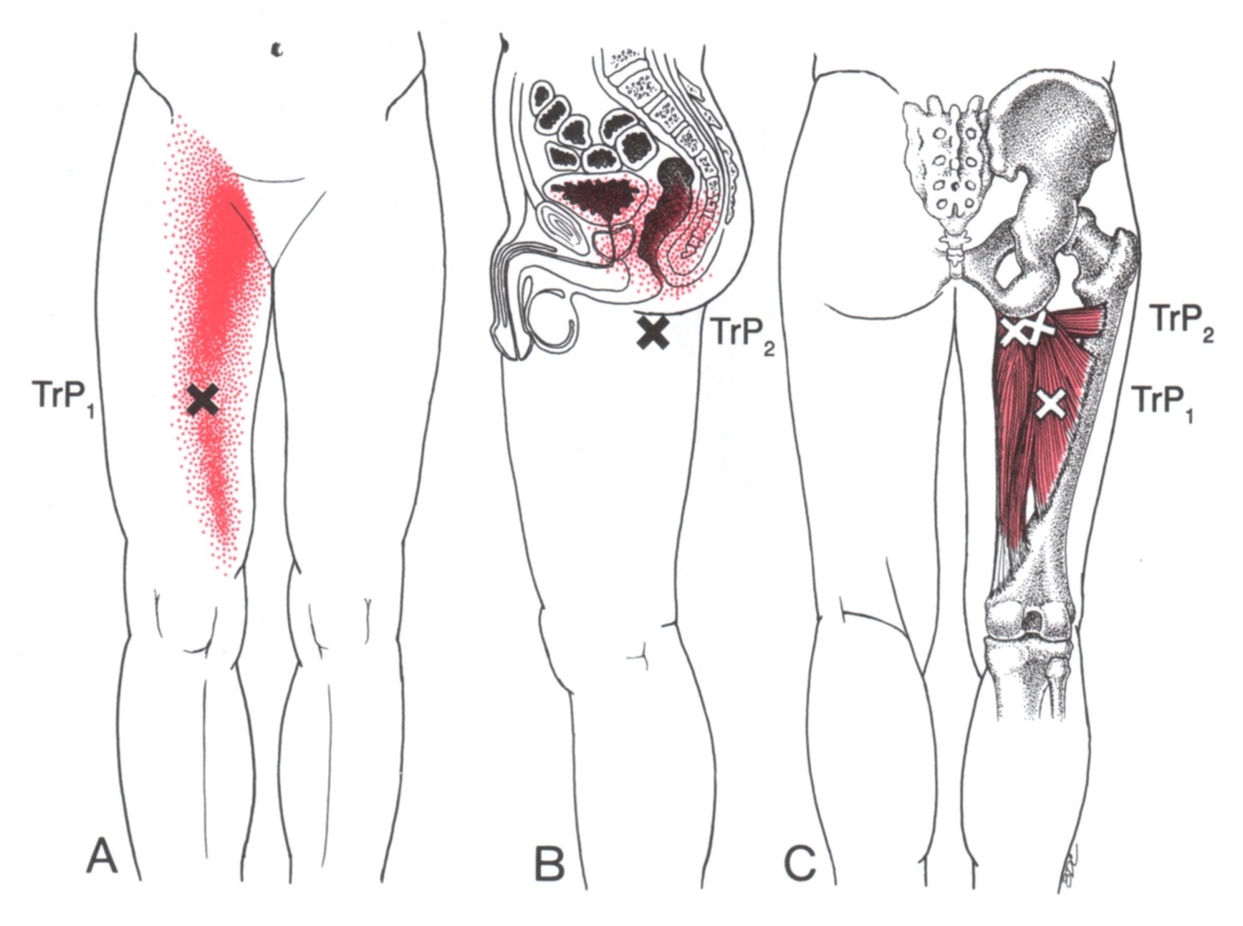 Adductor Magnus The Trigger Point Referred Pain Guide